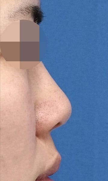 鼻尖縮小・軟骨移植 手術前 右側面