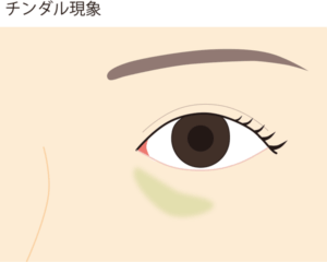 ヒアルロン酸で目の下が青くなる(チンダル現象)