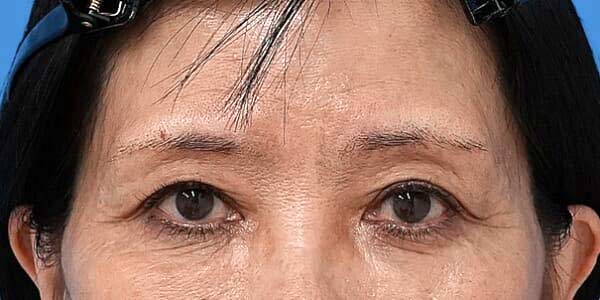 眉下切開 術後3か月のAfterの写真