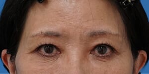 眉下切開 術後1か月