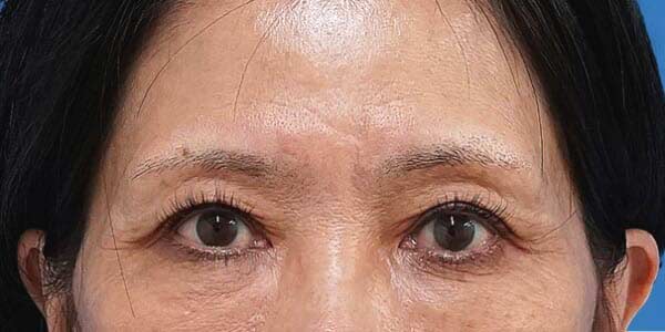 眉下切開 術後6か月のAfterの写真