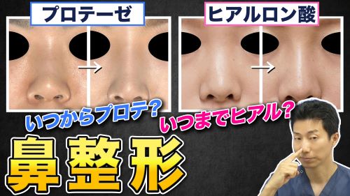【鼻整形】いつまでヒアルロン酸でいつからプロテーゼ？鼻筋に対するお悩みについて解説