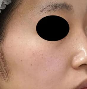 レーザー処置前