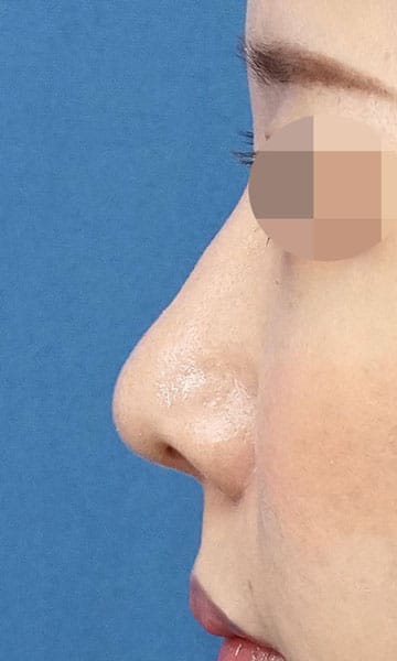 小鼻縮小（内側＋外側）、鼻尖縮小＋軟骨移植　３ヶ月後　左側面のAfterの写真
