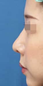 鼻翼縮小（内側＋外側）、鼻尖縮小、耳介軟骨移植　３ヶ月後　左側面