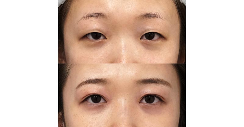 二重埋没法（３点連結埋没法）、目頭切開Z形成　６ヶ月後