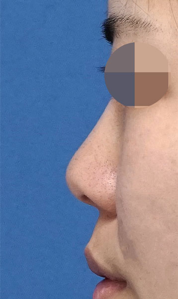鼻尖縮小・軟骨移植 手術前 左側面