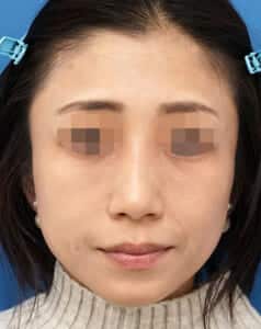 ゴルゴ線・目の下ほうれい線 1週間後