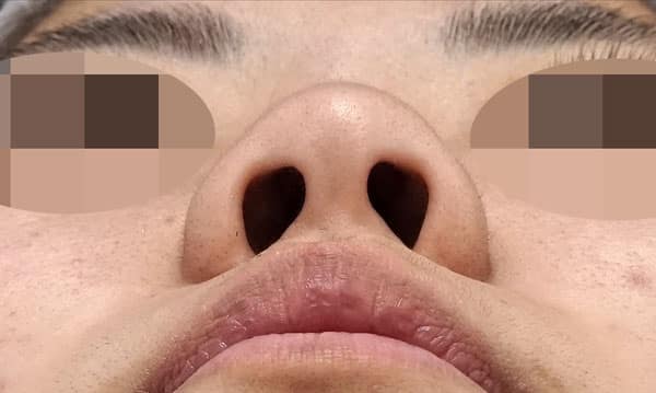 鼻尖縮小・軟骨移植 手術前 下から