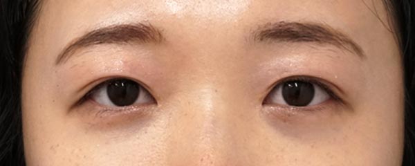 二重埋没法（もとびアイプラチナム）、目頭切開Z形成　６ヶ月後