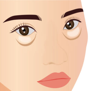 涙袋ヒアルロン酸がクマに見える