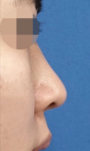 鼻尖縮小・軟骨移植 6ヶ月後 右側面