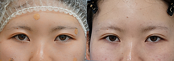 「二重が安定しない」悩みを改善。自然な平行型に仕上げる埋没法「もとびアイライト」