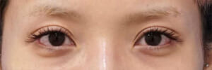切る眼瞼下垂　術後