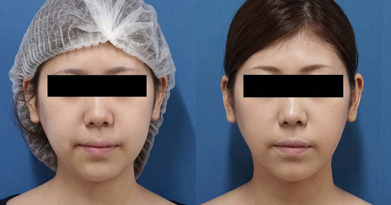 半永久のすっきり小顔に｜小顔脂肪吸引（ホホ・アゴ下）　７か月後