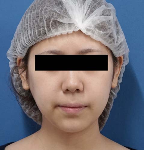 小顔脂肪吸引(ホホ・アゴ下) 手術前 正面