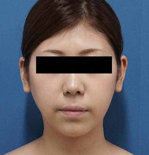小顔脂肪吸引(ホホ・アゴ下) 手術前 正面