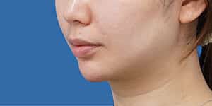 顎ヒアルロン酸 術直後 斜め