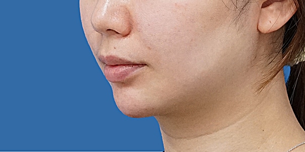 顎ヒアルロン酸 斜め 術直後のAfterの写真