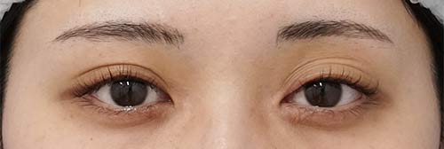 切らない眼瞼下垂プレミアム（二重埋没法）　手術前