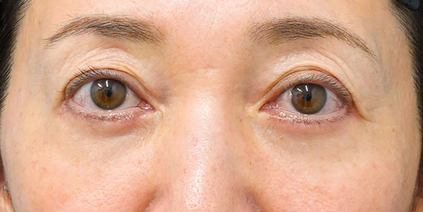 目の下たるみ取り（表ハムラ） １ヶ月後