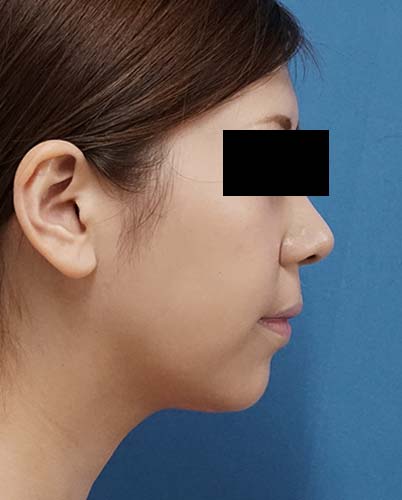 小顔脂肪吸引(ホホ・アゴ下) 7ヶ月後 右側面