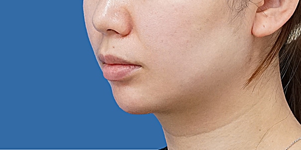 顎ヒアルロン酸 斜め 術直後のBefore写真