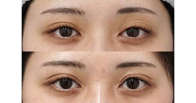 切らずに目力のある明るい目にできます｜切らない眼瞼下垂プレミアム　３ヶ月後