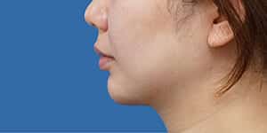 顎ヒアルロン酸 術直後 横