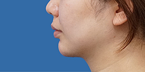 顎ヒアルロン酸 横 術直後のAfterの写真