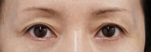 目の上ヒアルロン酸　処置後