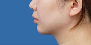 顎ヒアルロン酸 術前 横