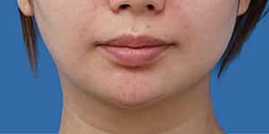 顎ヒアルロン酸 術直後 正面