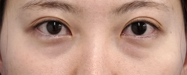 くま取り手術（裏ハムラ法）　手術前