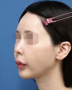 ホホ・貴族１週間後