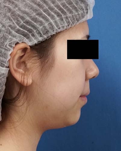 小顔脂肪吸引(ホホ・アゴ下) 手術前 右側面