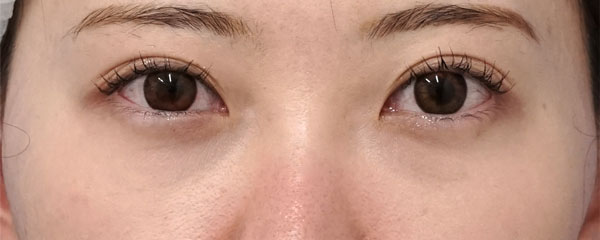 くま取り手術（裏ハムラ法）　２ヶ月後