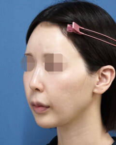 ホホ・貴族左斜め処置前