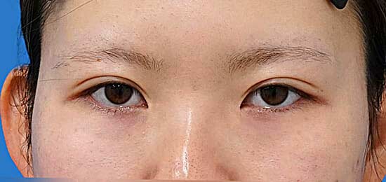 二重埋没（もとびアイライト）　術後3か月のAfterの写真