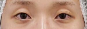切る眼瞼下垂　術前