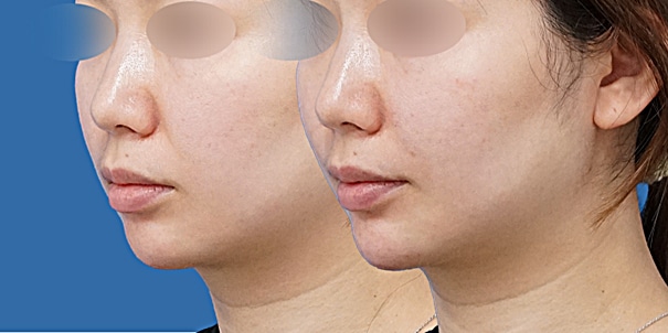 顎ヒアルロン酸のビフォーアフター