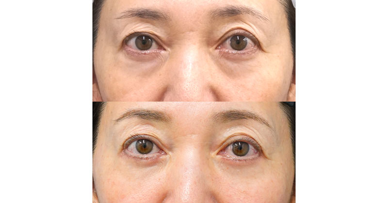 目の下のたるみもとって目元すっきり｜表ハムラ法　１ヶ月後