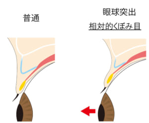 眼球突出（断面図）