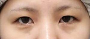 二重全切開症例写真　術前