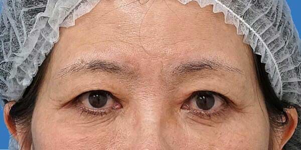 眉下切開 術後6か月のBefore写真