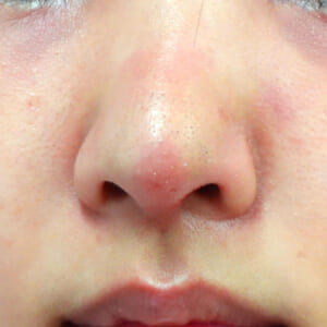 鼻の赤み、腫れ