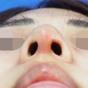 鼻の赤み、腫れ