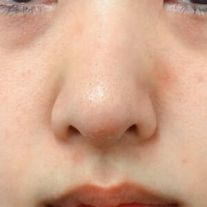 鼻整形後の感染