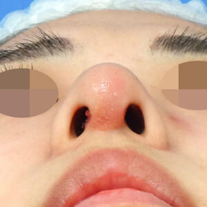 鼻整形後の感染