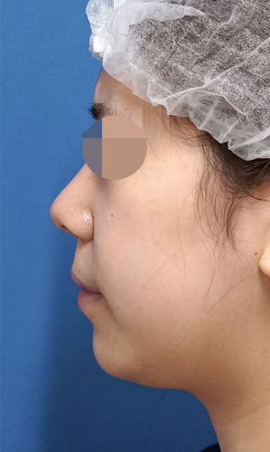 小顔脂肪吸引(ホホ・アゴ下) 手術前 左側面